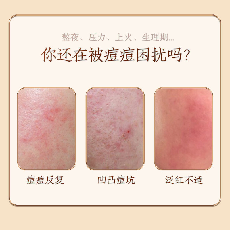 片仔癀牌祛痘套装舒缓凝胶祛痘膏舒缓痘肌保湿肌肤祛痘痘官方正品