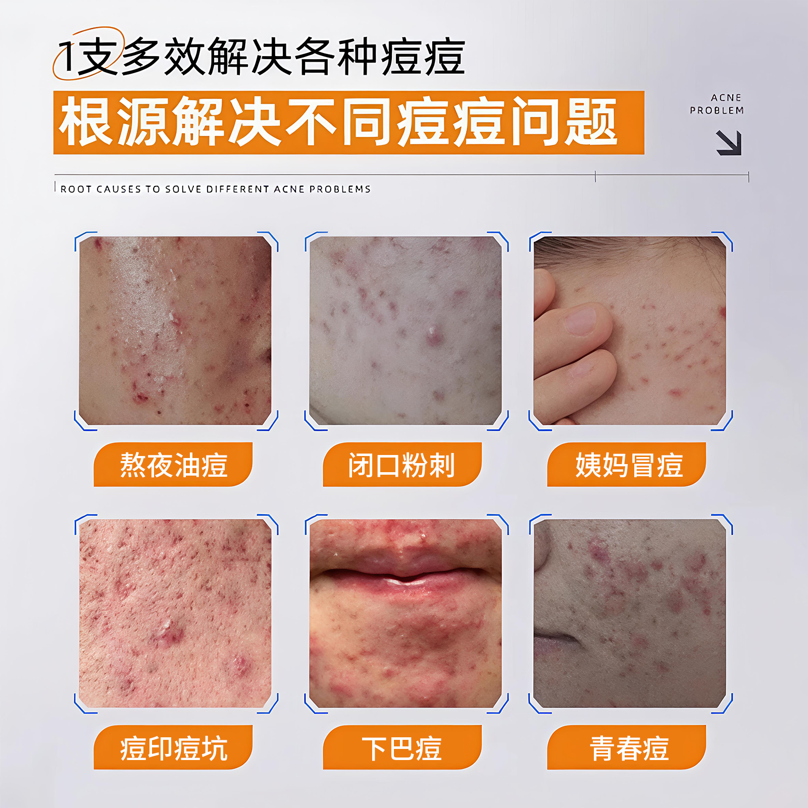 片仔癀牌祛痘套装舒缓凝胶祛痘膏舒缓痘肌保湿肌肤祛痘痘官方正品