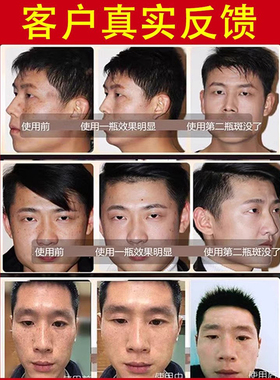 祛斑神器男士专用同仁堂祛斑霜