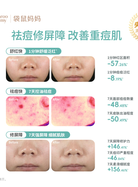 袋鼠妈妈青少年苦丁茶祛痘精华霜青春期学生保湿淡痘印修屏障面霜