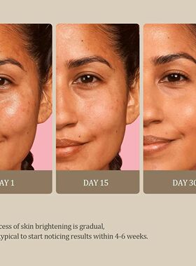 Turmeric Kojic Acid Glow Soap Dark Spot Acne Removal Even Sk