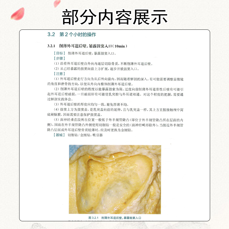 正版颞骨解剖实战指导 宋跃帅 龚树生 著 书中的解剖应用了*精简的器械和设备 降低读者实施的难度 人民卫生出版社9787117308960 - 图3