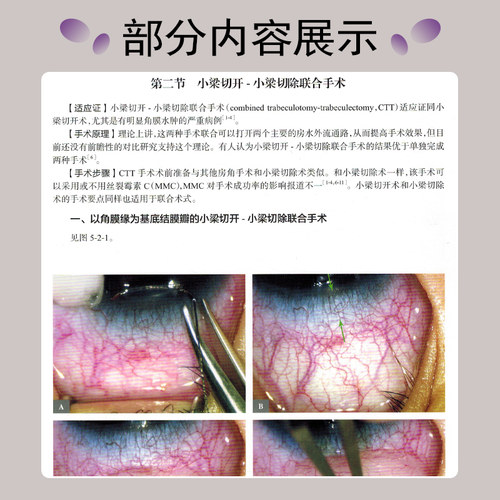 正版 图解青光眼手术操作与技巧 超值附赠108个网络增值视频 张秀兰 王宁利著 人民卫生出版社9787117228190 - 图3