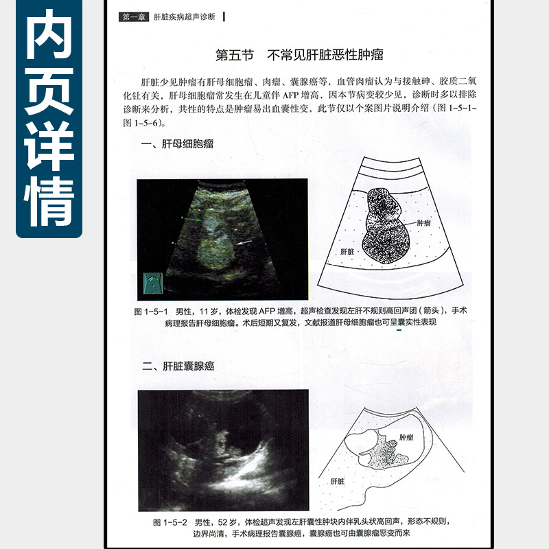 正版 实用腹部超声诊断图解 主编刘学明 蒋天安  腹部疾病医学超声技术声学造影工具书 人民卫生出版社9787117269483