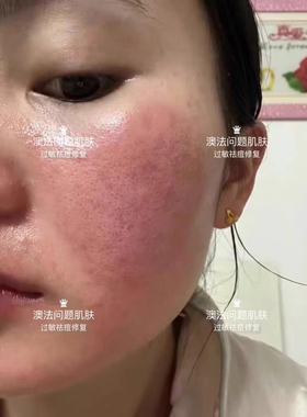 红脸救星面部泛红大红脸红血丝修复敏感增后角质层皮肤屏障保湿