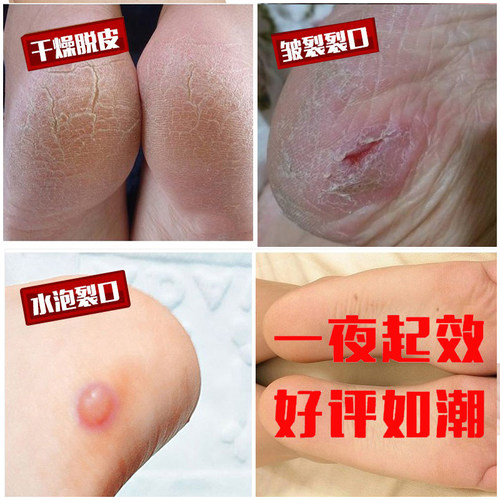 6只硅胶脚后跟防干裂保护套防裂袜护脚套后跟套足跟脚跟裂袜套女 - 图0
