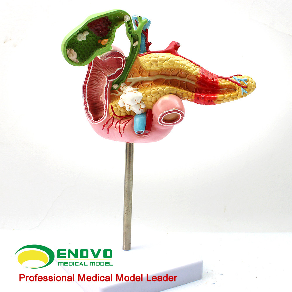 ENOVO颐诺医学胰腺十二指肠胆囊病理模型外科消化科系统模具肝胆科模型专科医生医学住院医师教学上海教具,淘宝优惠券,粉丝福利购,淘宝优惠卷