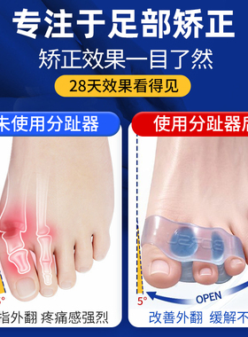 拇指外翻脚趾矫正器硅胶分趾器大拇脚趾分离器可穿鞋套