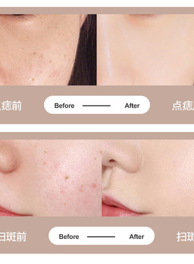 点痣笔美容院专用小白扫斑点痣点疣笔扁平疣仪器激光点斑消痣神器
