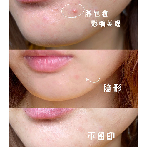 olive young痘痘贴绿色积雪草修护急救可上妆青春痘消净痘不留痕 - 图1