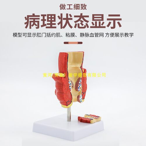 教学仿真直肠病理模型肠道标本人体解剖模型痔疮肛门病变医学教具 - 图0