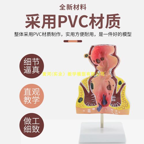 教学仿真直肠病理模型肠道标本人体解剖模型痔疮肛门病变医学教具 - 图2