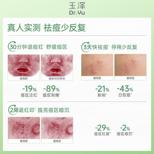 玉泽四酸点痘笔祛痘精华油皮痘肌修护控油青蒿舒缓退红印闭口粉刺 - 图3