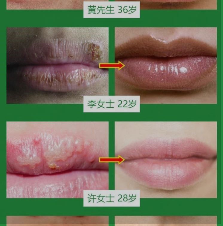 百约王唇疱康唇炎专用药唇膏死皮嘴唇干裂嘴角燎泡上火口唇干燥 - 图0