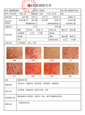 便携式皮肤镜色斑红血丝毛孔
