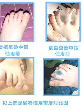 儿童脚趾矫正器食指重叠