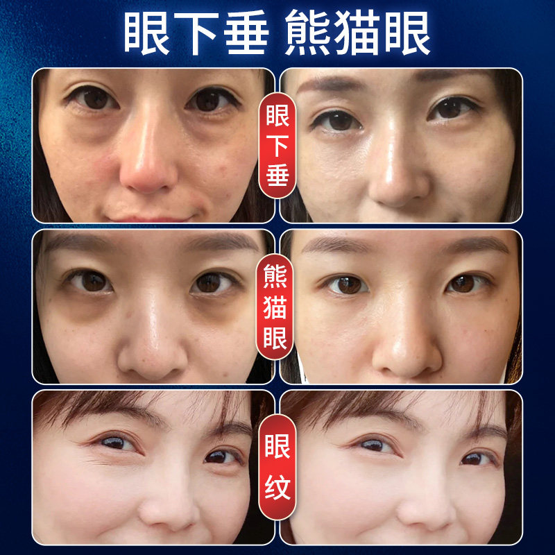 仁和蛇毒抗皱去除黑眼圈细纹眼霜 水木花草眼霜