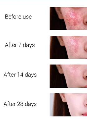 Effective Acne Removal Cream Treatment Acne Scar Spots Cream