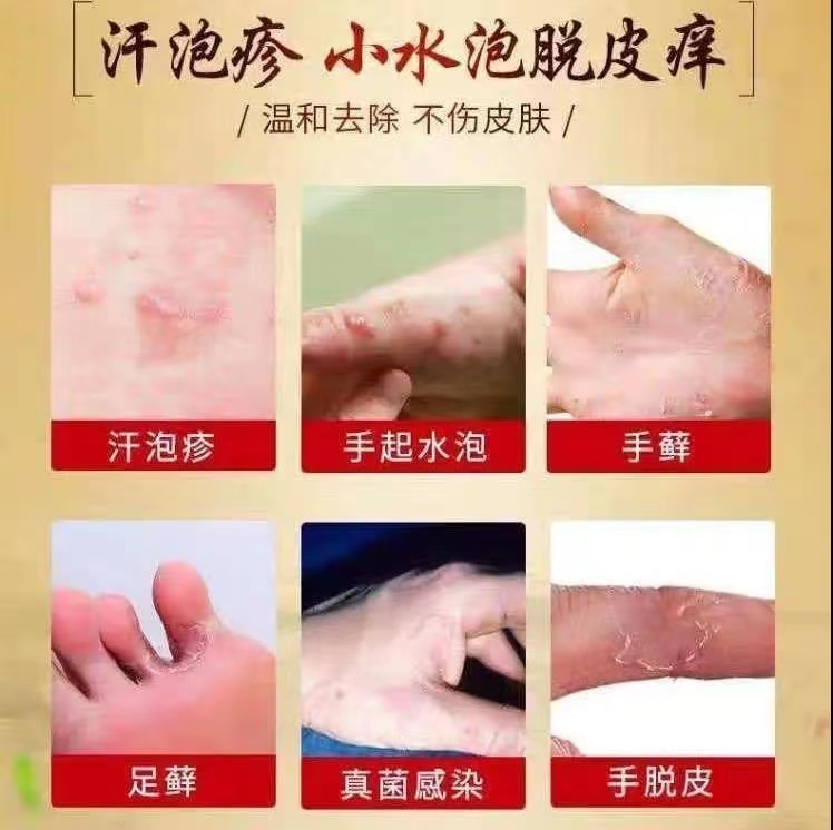 汗泡疱疹药膏手上起小水泡汗状疱疹止痒汉状真菌感染手专用软膏-图0