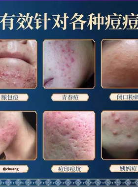 圣星苗方苗山斗豆液祛痘精华液