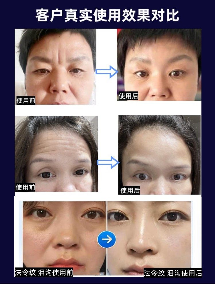 冻干水光脸颊额头填补套盒皱纹贴泪沟川字纹胶原精华补充贴,淘宝优惠券,粉丝福利购,淘宝优惠卷