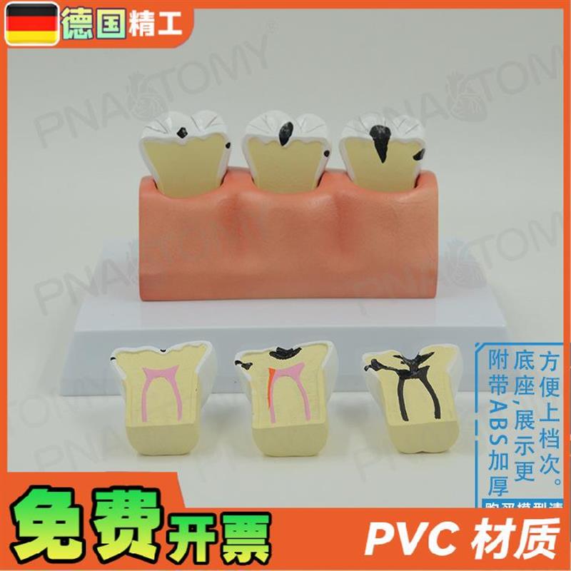 德国】牙科牙g齿龋齿解剖分解模型口腔科牙科病理蛀牙模型 教学展 - 图0