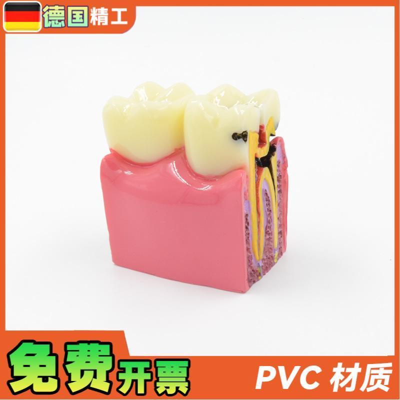 德国】六倍龋齿对比模q型口腔牙齿模型口腔教学蛀牙切面模型牙 - 图2