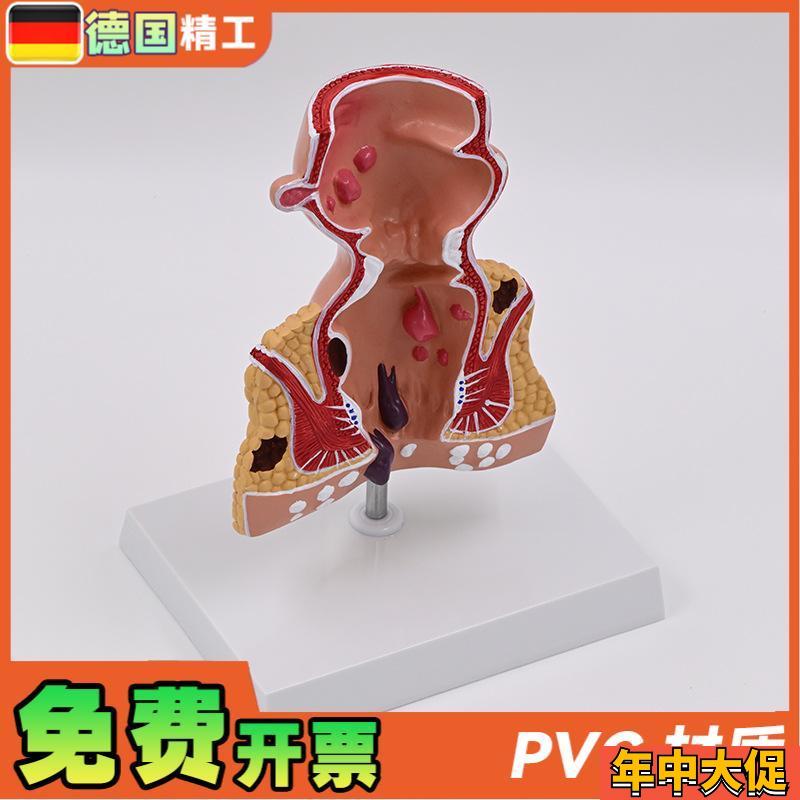 德国】新款大促爆款人体模型肠A直肠解剖病理模型病态疾病教具模 - 图1