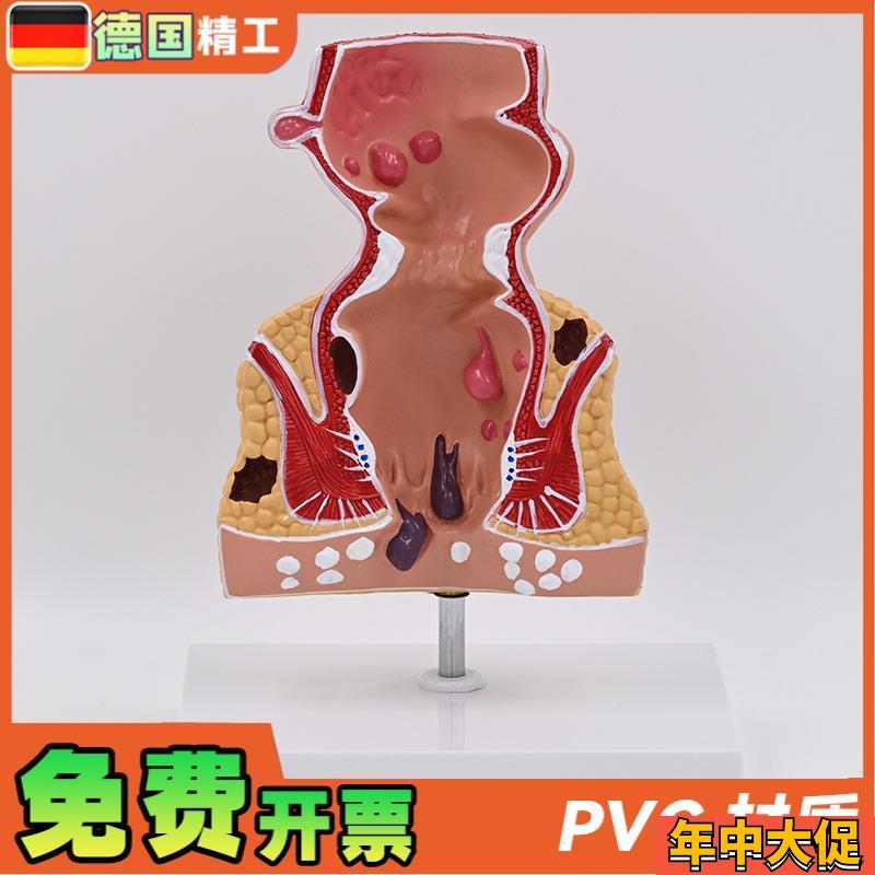 德国】新款大促爆款人体模型肠A直肠解剖病理模型病态疾病教具模 - 图0