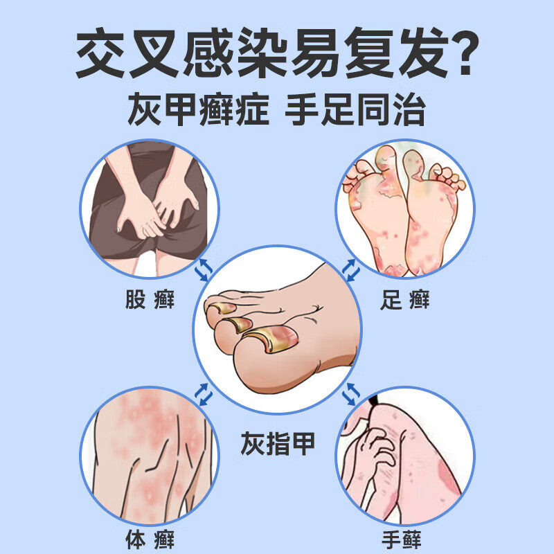 环吡酮胺乳膏正品止痒脱皮灰指甲真菌感染手足体股癣抗真菌药膏H