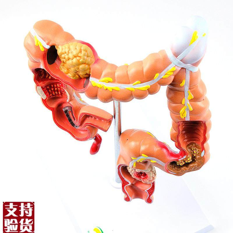 ENOVO颐诺h人体大肠疾病展示模型结肠直肠道病变症状消化系统疾病,淘宝优惠券,粉丝福利购,淘宝优惠卷