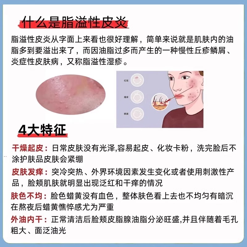 面部脂溢性皮炎鼻子鼻翼修复喷雾面膜面霜剂脸上脸部溢脂性皮炎DS - 图1