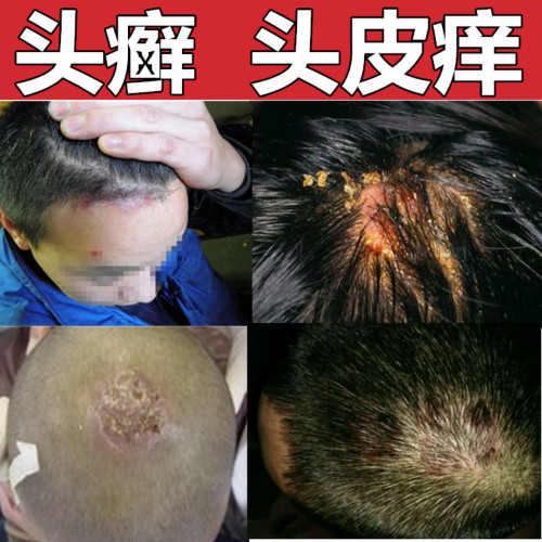 去毛囊炎的洗发水头皮去屑止痒药膏 弘顺富医疗器械皮肤消毒护理（消）
