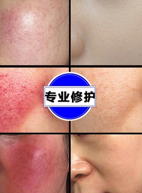 敏感肌德康凯琳角质层薄红血丝