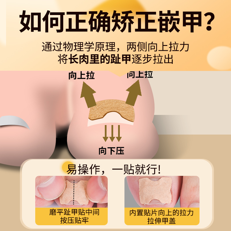 甲沟矫正器正甲贴脚指甲炎嵌甲工具专用指甲贴德国甲床趾甲固定器 - 图1