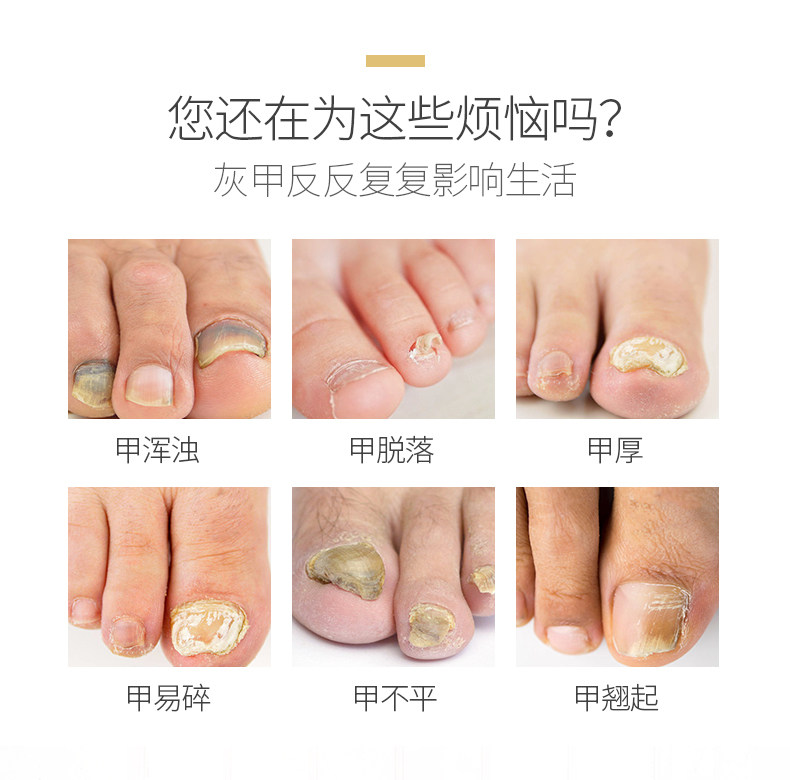 灰指甲正品非治疗药专用液脱甲膏 本义医疗器械保健理疗