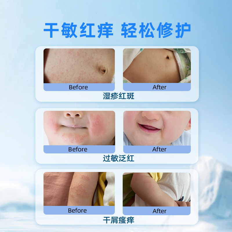 儿童湿疹膏无激素医用 干性痒特应性皮炎婴儿宝宝湿疹专用