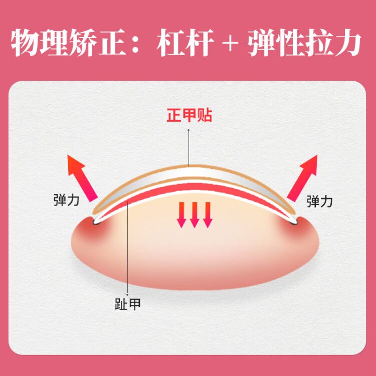 甲沟矫正器正甲贴嵌甲指甲神器长肉里趾甲贴片脚甲纠炎修正修脚沟-图1