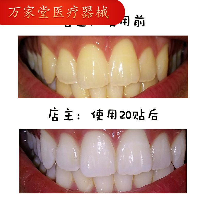 美白牙贴女5片美国版3d white 万家堂医疗器械针灸器具（器械）