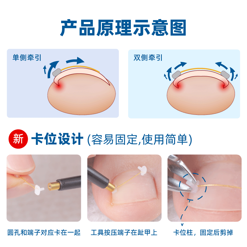 修脚师专用 镍钛合金甲沟嵌甲矫正记忆钢丝 指甲器正甲贴片炎 - 图2