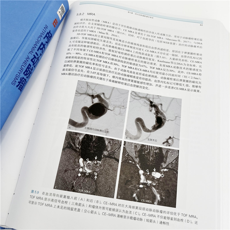 颅内动脉瘤 胚胎学病理学生理学流行病学实验动脉血诊断学治疗学 治疗理念系统指导临床诊疗 赵继宗推荐 临床医师治疗参考图书籍 - 图0