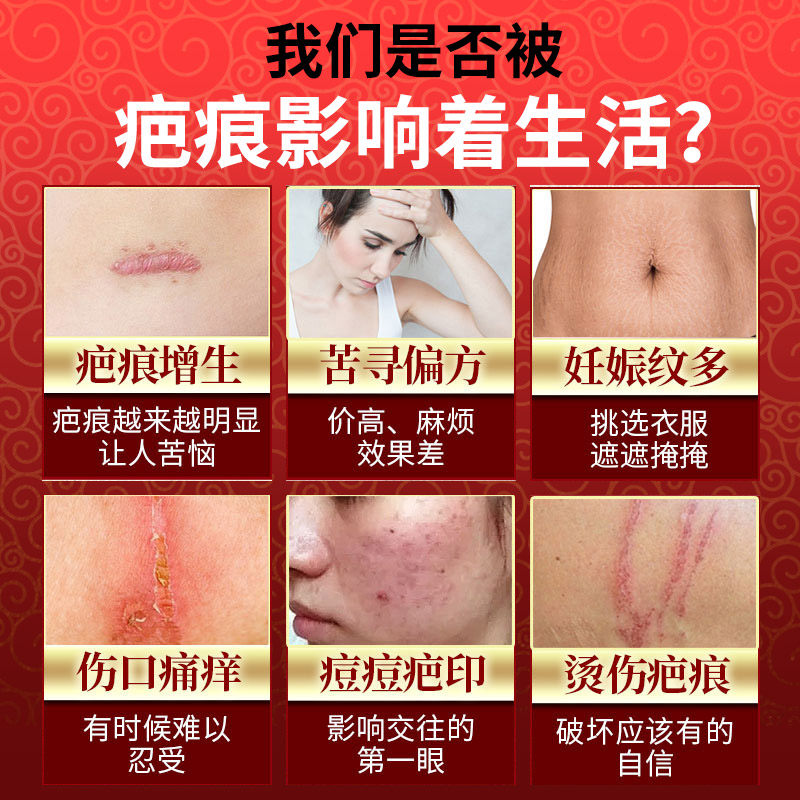 妙丹堂疤痕灵脸部痘印修复手术凝胶 健蓓莱医疗器械祛疤产品