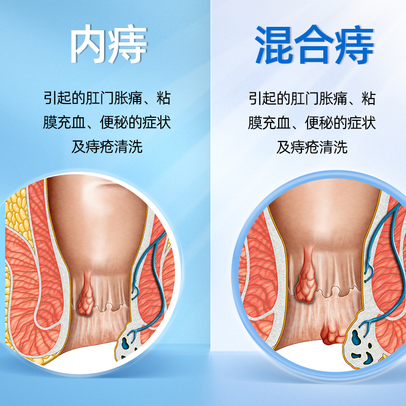 医用卡波姆痔疮洗液消肉球混合痔疮内痔瘙痔消肿疮清洗液坐浴正品 - 图1