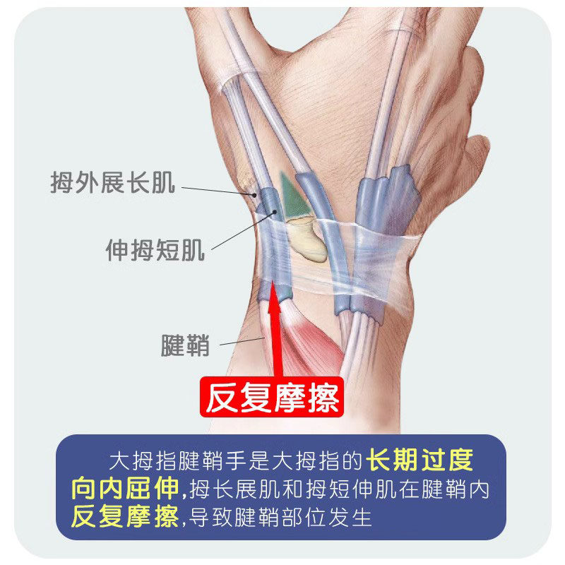 手腕保护套大拇指支具预防腱鞘护腕 缇健堂护具（器械）