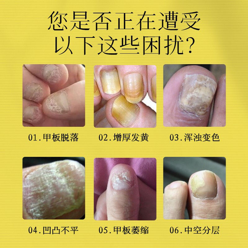 仁和灰指甲专用冰醋酸30涂剂 tm软膏 淮南药之都大药房保健理疗