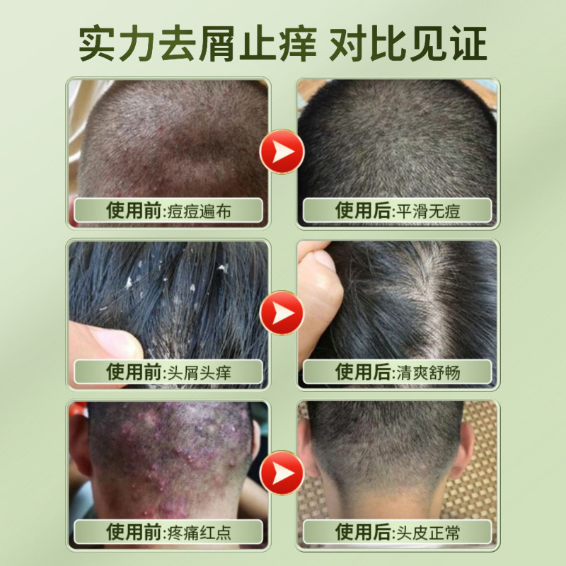 仁和皮肤抑菌液毛囊炎护理洗发水 奈格尔医疗器械皮肤消毒护理（消）