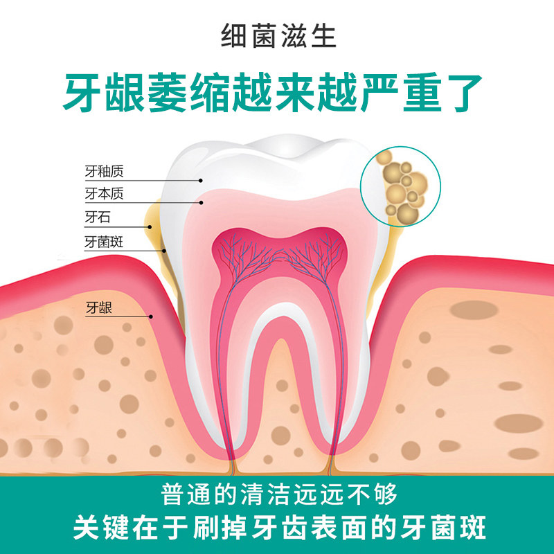 牙周炎牙齿松动牙龈萎缩修复cw牙膏 肯芙洛牙齿脱敏剂