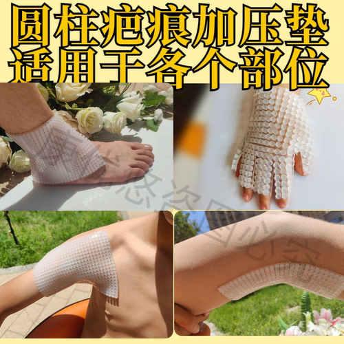 3D圆柱疤痕加压垫烧烫伤儿童医用术后凸起防增压生贴硅凝胶增压垫 - 图1