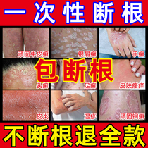 Curing Bull Peel of Psoriasis Cream Psoriasis Cream Skin Pruritus Eczema Root to anti-itch head stock Hand Foot Tinea special ointment