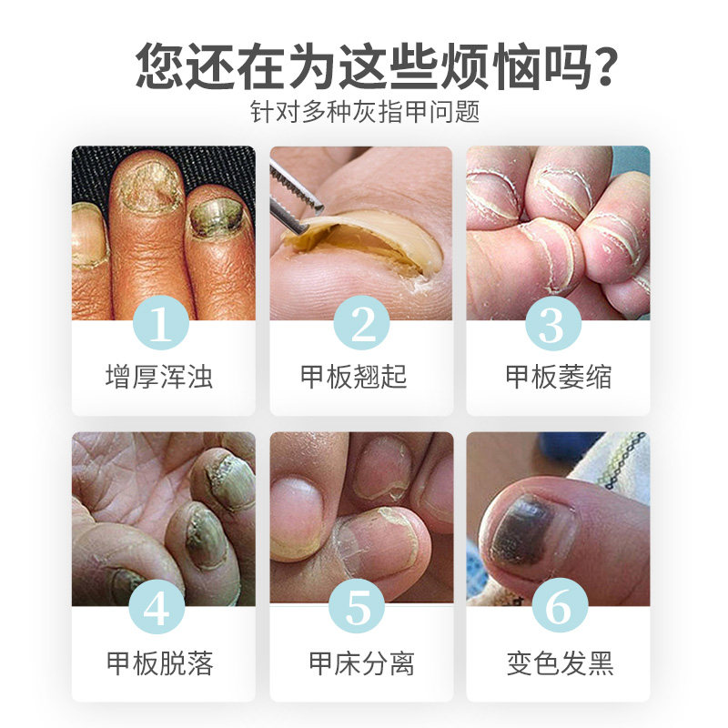 仁和康宝灰指甲治疗专用药h冰醋酸 小禾诗蔓医疗器械保健理疗